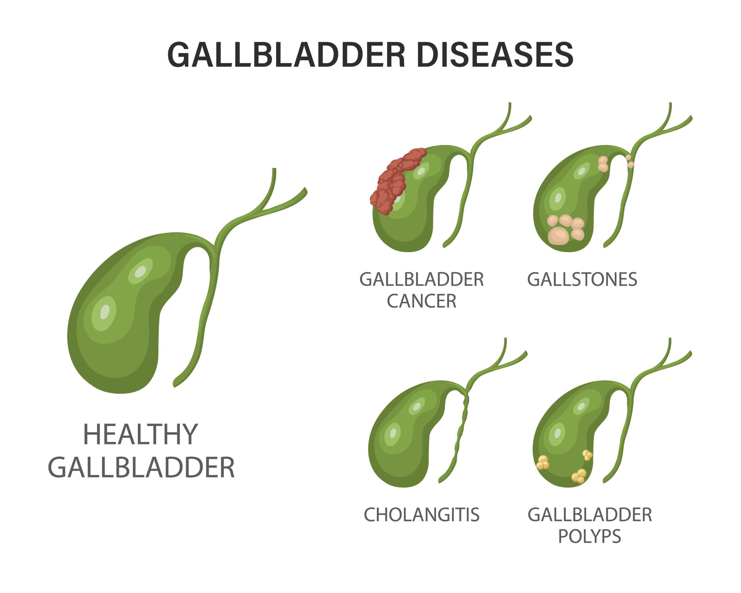 Understanding Gallbladder Disease: Risks and Symptoms